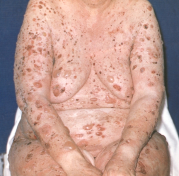 Рис. 2. Больная вульгарной пузырчаткой: процесс распространен по всей коже