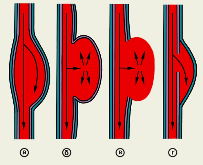 Схематическое изображение различных видов артериальных аневризм: а — истинная; б — грыжевидная; в — ложная; г — расслаивающая. Стрелками обозначены направления тока крови
