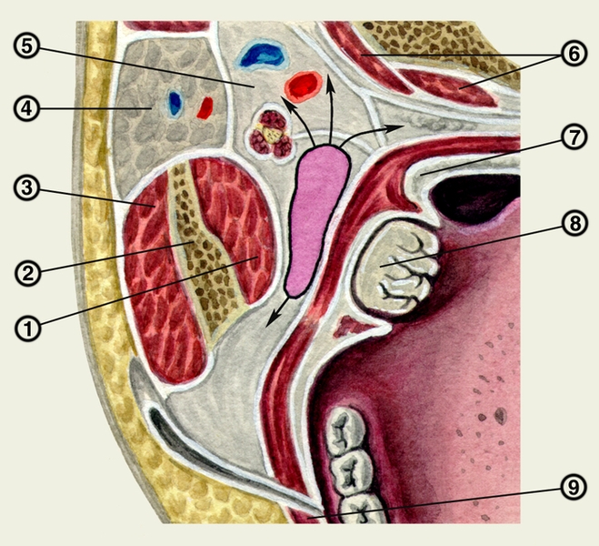 Схематическое изображение распространения инфекции при окологлоточном абсцессе (горизонтальный распил на уровне нижней трети головы): 1 — медиальная крыловидная <a href=