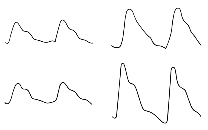 Рис. 4. Исходные реовазограммы голени (слева) и их динамика (справа) при положительных постуральной (вверху) и нитроглицериновой (внизу) пробах