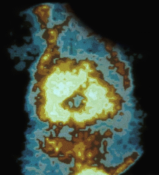 Рис. 7. Сцинтиграмма расположенной на передней стенке матки плаценты с участком некроза — «мертвая зона» в центре плаценты