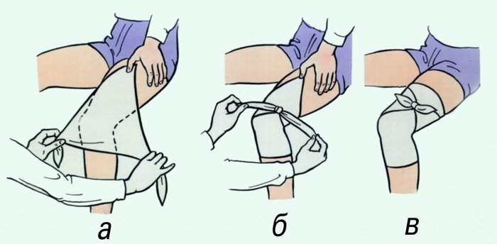 Рис. 4. Косыночная повязка на коленный сустав: а, б, в — этапы <a href=