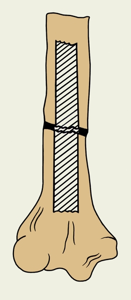 Рис. а). Схематическое изображение некоторых методов костной пластики при переломах: интрамедуллярная <a href=