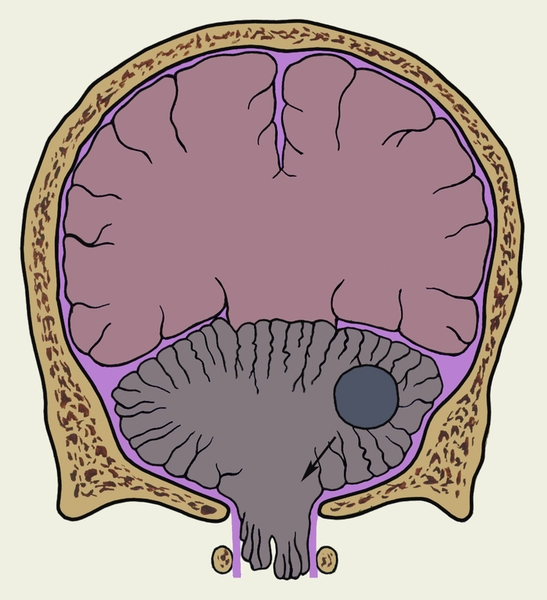 Рис. 1. Схематическое изображение фронтального разреза головы при синдроме затылочного вклинения, обусловленном опухолью мозжечка: стрелка, идущая от опухоли, показывает направление вклинения миндалин мозжечка