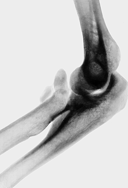 Рис. 11б). Рентгенограмма локтевого сустава при оскольчатом переломе головки лучевой кости (боковая проекция)