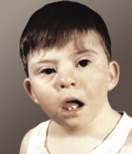 Рис. 1а). Некоторые внешние признаки болезни Дауна у ребенка 4 лет: косо расположенные глазные щели, эпикант, уплощенная широкая переносица, полуоткрытый рот, деформированные ушные раковины