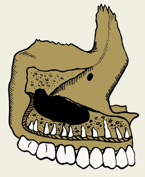 Взаимоотношение дна верхнечелюстной пазухи (черного цвета) и корней зубов верхней челюсти
