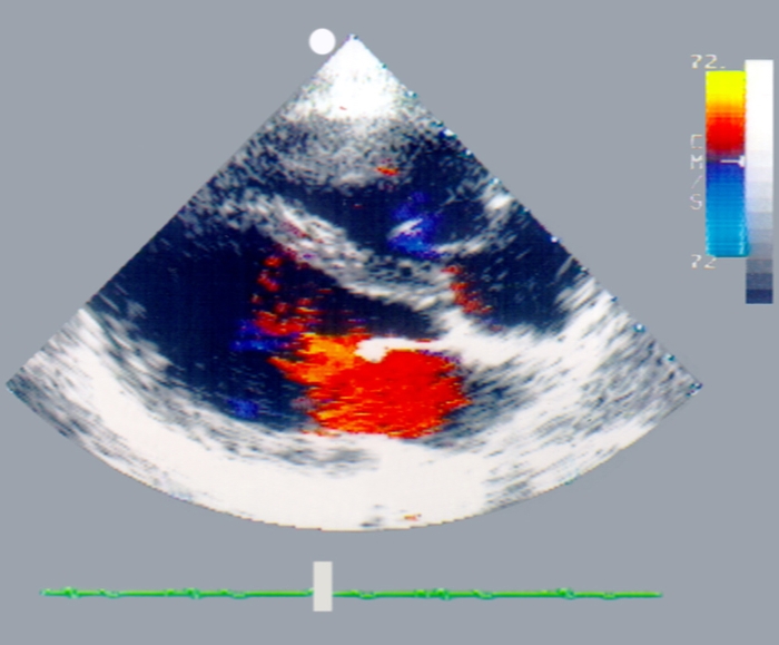 Рис. 6а). Двухмерная цветная допплер-эхокардиограмма с изображением сердца в проекции длинной оси: в период диастолы, красный цвет указывает направление потока крови в сторону датчика, поток соответствует фазе быстрого наполнения левого желудочка. Справа от эхокардиограммы видна цветовая шкала потоков и шкала акустической плотности