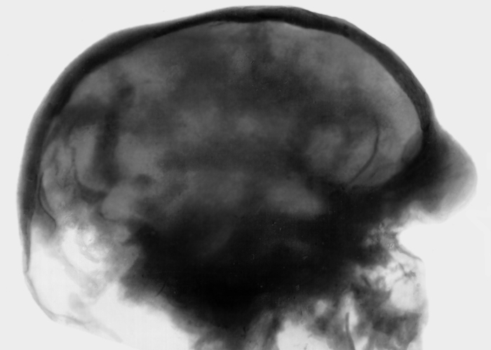 Рис. 43. Рентгенограмма черепа при фронтометафизарной дисплазии: отсутствие фронтального синуса, лобная кость выступает кпереди