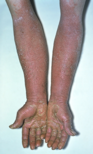 Рис. 2. Аллергический дерматит, вызванный спиртовым раствором левомицетина: эритематозно-везикулезные <a href=