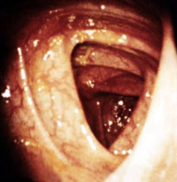 Рис. 3а). Эндоскопическая картина толстой кишки в норме: хорошо виден просвет кишки, слизистая оболочка обычной окраски, складки ее глубокие, остроконечные