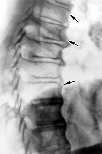 Рентгенограмма грудного отдела позвоночника (боковая проекция) при болезни Форестье: утолщение передней продольной связки (указано стрелками)