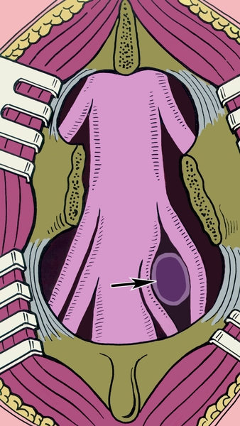 Рис. 5. Схематическое изображение грыжи межпозвоночного диска, сдавливающей два корешка спинного мозга: грыжа указана стрелкой
