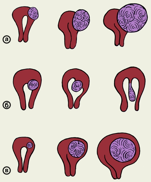 Рис. 1. Схема развития подбрюшинной (а), подслизистой (б) и межмышечной (в) миомы матки