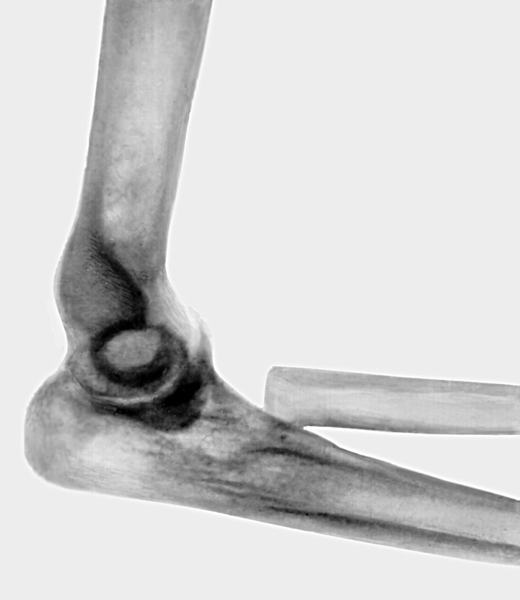 Рис. 11в). Рентгенограмма локтевого сустава при переломе головки лучевой кости — после резекции головки лучевой кости (боковая проекция)