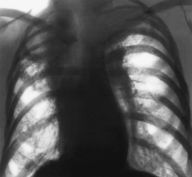Рис. 8а). Рентгенограмма грудной клетки при посттуберкулезном циррозе верхней доли правого легкого: верхняя <a href=