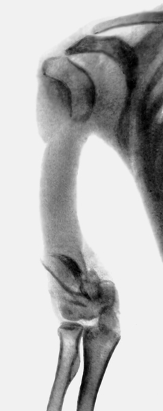 Рис. 2а). Рентгенограмма правой верхней конечности при прогрессирующем остеолизе плечевой кости: до лечения (отсутствует <a href=