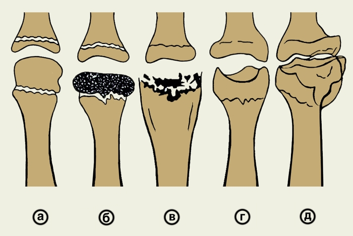 Рис. 1. Схематическое изображение эволюции изменений головки II плюсневой кости при болезни Келер II: а — I стадия (подхрящевой некроз кости), изменения на рентгенограмме не выявляются; б — II стадия (импрессионный <a href=