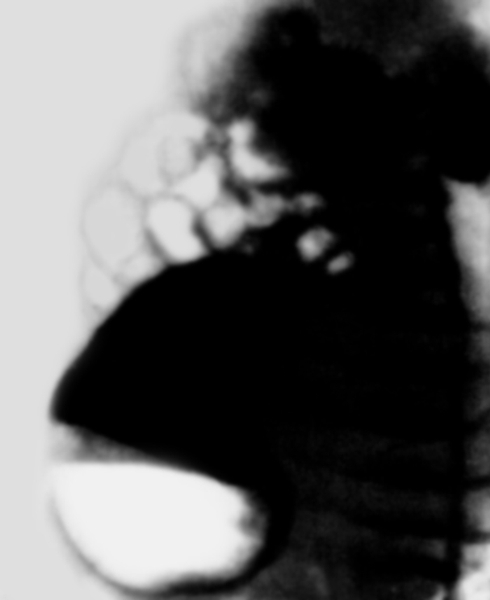 Рис. 2а). Рентгенограмма желудка ребенка с пилоростенозом (прямая проекция) через 30 мин после приема бариевой взвеси: отмечается задержка эвакуации содержимого желудка