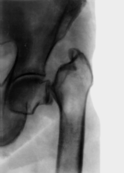 Рис. 2. Рентгенограмма области тазобедренного сустава (прямая проекция) при патологическом переломе шейки бедренной кости у <a href=