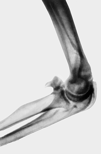 Рис. 13б). Рентгенограмма локтевого сустава при параартикулярной оссификации — боковая проекция