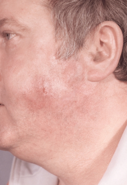 Рис. 1. Фурункул лица: формируется воспалительный инфильтрат с гиперемией кожи над ним