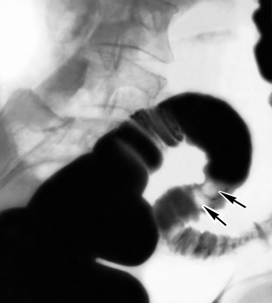 Рис. 3. Рентгенограмма сигмовидной ободочной кишки при полипозе (стрелками указаны дефекты наполнения)