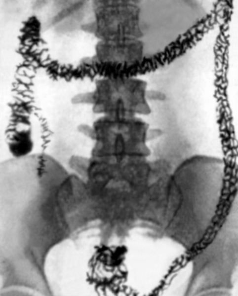 Рис. 1б). Обзорная рентгенограмма толстой кишки в норме после удаления из кишечника рентгеноконтрастной взвеси