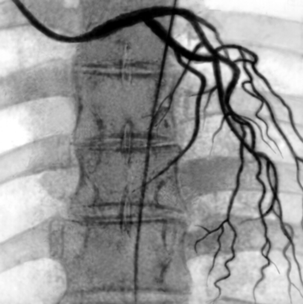 Рис. 2. Ангиограмма левой венечной артерии в норме (прямая проекция)