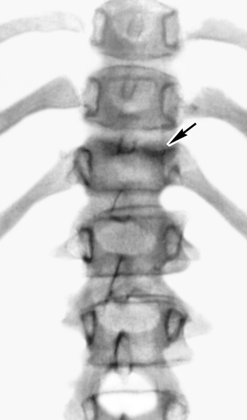 Рис. 5а). Рентгенограмма позвоночника при гематогенном гнойном спондилите (прямая проекция): ограниченное поражение по типу «дисцита» с субхондральной деструкцией XII грудного позвонка (указано стрелками)