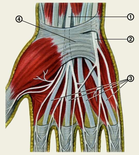 Рис. 1б). Схематическое изображение механизмов развития некоторых туннельных синдромов (пунктирной линией обозначен сдавливаемый участок нерва). Сдавление срединного нерва в запястном канале удерживателем сгибателей: 1 — срединный нерв, 2 — локтевой нерв, 3 — сухожилия сгибателей пальцев, 4 — удерживатель сгибателей