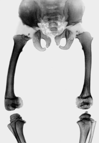 Рис. 27. Рентгенограмма тазобедренных суставов при псевдоахондроплазии: таз широкий, головки бедренных костей малого размера