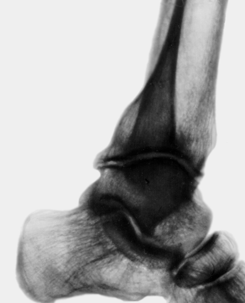 Рис. 2б). Рентгенограмма голеностопного сустава при постартрическом остеоартрозе: сужение суставной щели и краевые костные разрастания (боковая проекция)