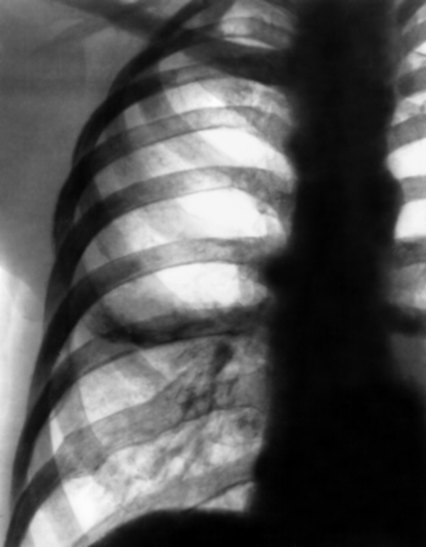Рис. 11. Фрагмент рентгенограммы органов грудной клетки в прямой проекции при интерстициальной пневмонии: в нижнем поясе правого легочного поля легочный рисунок усилен и деформирован, радиальная его направленность не прослеживается