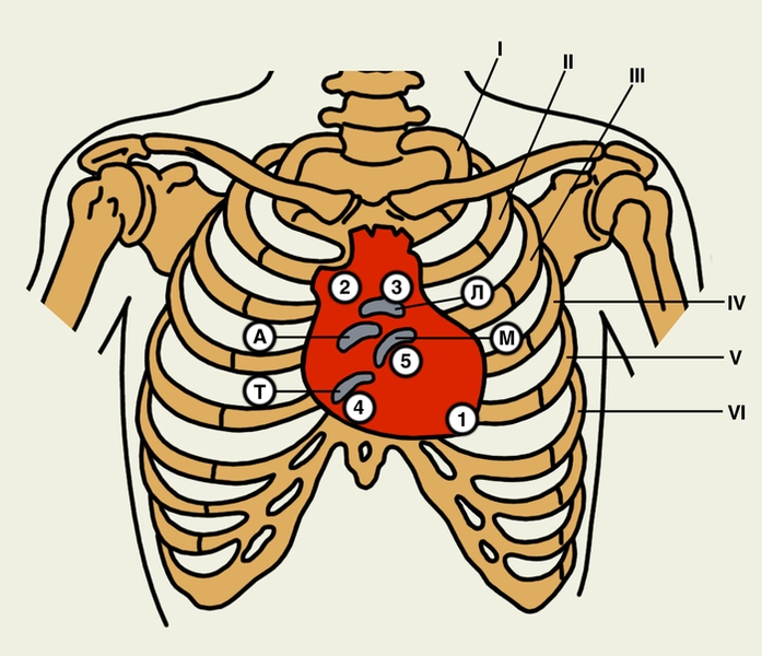 Рис. 1. Схема проекции клапанов сердца на переднюю грудную стенку (А — проекция клапана аорты; Л — проекция клапана легочного ствола; М — проекция митрального клапана; Т — проекция трехстворчатого клапана) и основные точки выслушивания шумов сердца: 1 — <a href=