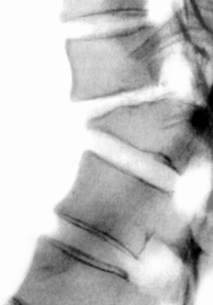 Рис. 10в). Рентгенограмма поясничного отдела позвоночника (боковая проекция) при компрессионном переломе с тяжелой степенью компрессии