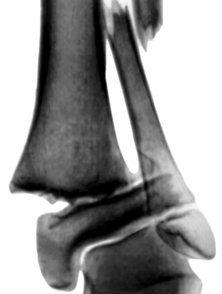 Рис. 3а). Рентгенограмма голеностопных суставов при переломах образующих их костей у детей: <a href=