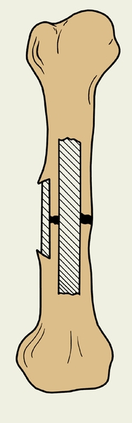 Рис. б). Схематическое изображение некоторых методов костной пластики при переломах: интраэкстрамедуллярная костная пластика по Чаклину; трансплантаты заштрихованы