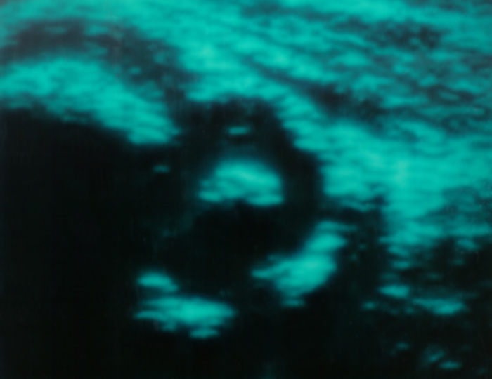 Рис. 7б). Ультрасонограмма тазобедренного сустава с 1 типом строения (подтип А) у ребенка первых месяцев жизни