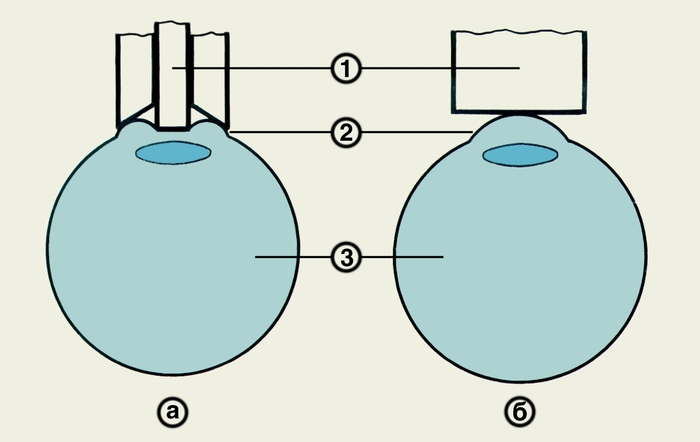 Рис. 1. Схематическое изображение принципов импрессионной (а) и аппланационной (б) тонометрии: 1 — контактирующая с роговицей рабочая часть тонометра; 2 — <a href=
