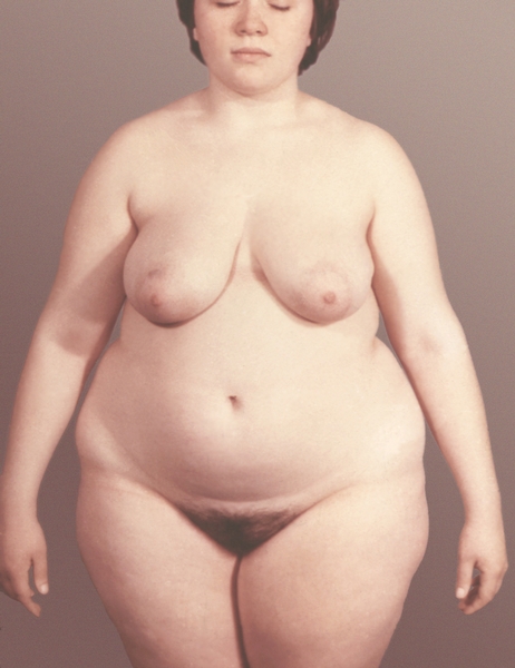 Рис. 1а). Больная с экзогенно-конституциональным ожирением: относительно равномерное распределение жировой ткани
