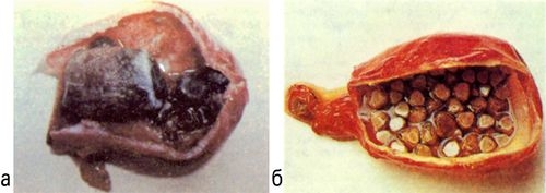 Рис. 1. Макропрепараты желчного пузыря при желчнокаменной болезни: а — большой пигментно-холестериновый камень, заполняющий просвет желчного пузыря; стенки пузыря утолщены, на его внутренней поверхности имеются пролежни (указаны стрелками); б — мелкие фасетированные холестериново-пигментные камни в просвете желчного пузыря