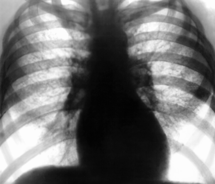 Рис. 1. Обзорная рентгенограмма грудной клетки при II стадии интерстициального пневмокониоза: отмечается сетчатая деформация легочного рисунка, видны многочисленные мелкие затенения, обусловленные перекрестом теней фиброзных тяжей; корни легких неструктурны; базальные отделы легких эмфизематозны