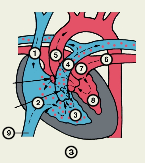 Рис. 23з). Схематическое изображение отдельных врожденных пороков сердца (направления кровотока обозначены пунктирными стрелками, локализация пороков — сплошными стрелками): прорыв аневризмы синуса Вальсальвы; 1 — верхняя полая вена, 2 — правое предсердие, 3 — правый желудочек, 4 — легочный ствол, 5 — аорта, 6 — легочная вена, 7 — левое предсердие, 8 — левый желудочек, 9 — нижняя полая вена