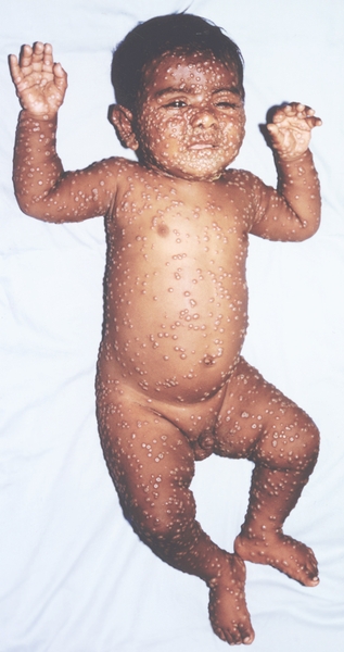 Рис. 1. Общий вид ребенка, больного натуральной оспой: пустулезная сыпь (8-й день высыпания)