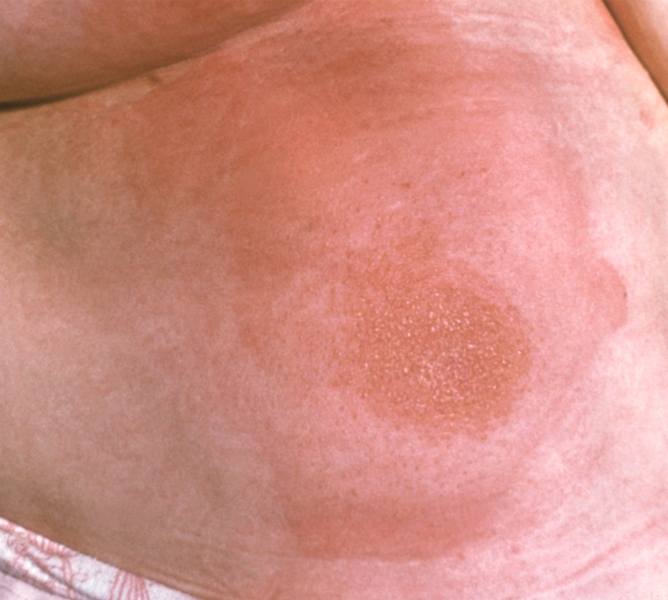 Рис. 5а). Аллергический дерматит, вызванный мазью, содержащей ментол: везикуло-папулезные высыпания на эритематозном фоне на коже живота и молочной железе