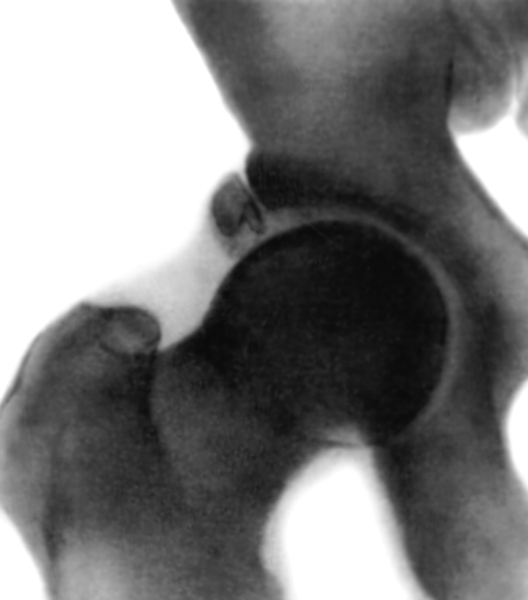 Рис. 6б). Рентгенограмма тазобедренного сустава (прямая проекция) взрослого в норме: у края вертлужной впадины видны добавочные костные образования (неслившиеся ядра окостенения)