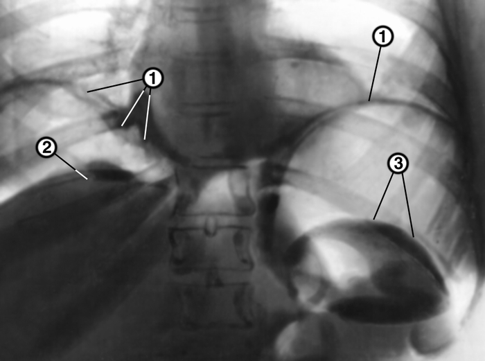 Рентгенограмма брюшной полости после наложения пневмоперитонеума в норме (положение больного вертикальное): определяются правый и левый куполы диафрагмы (1), верхняя поверхность печени (2), верхненаружный контур селезенки (3)