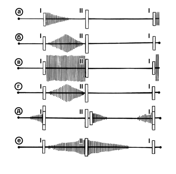 Рис. 3. Схема фонокардиографического изображения сердечных шумов (заштрихованные участки) при некоторых пороках сердца в соотношении с I и II сердечными тонами: a — убывающий протосистолический шум при митральной недостаточности; б — ромбовидный мезосистолический шум при аортальном стенозе; в — голосистолический шум при дефекте межжелудочковой перегородки; г — веретенообразный голосистолический шум при стенозе легочного ствола; д — пресистолический (в связи с митральным стенозом) и протодиастолический (в связи с аортальной недостаточностью) шумы; е — систолодиастолический шум при открытом артериальном протоке