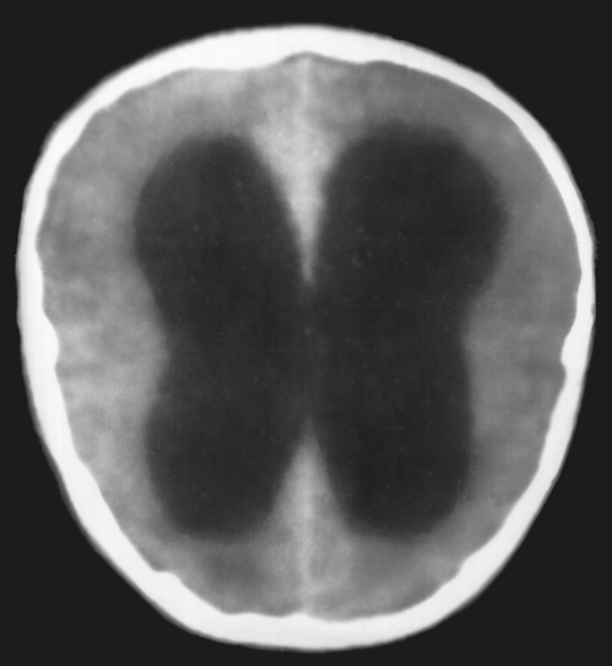 Рис. 2а). Компьютерная томограмма головы при окклюзии на уровне водопровода мозга воспалительного генеза